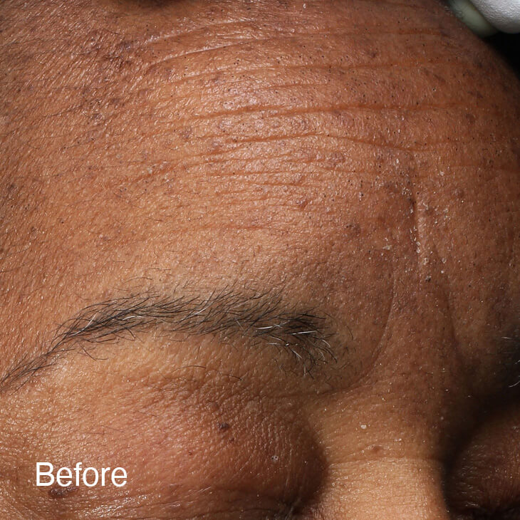 Treatment Results Patient 2 Before